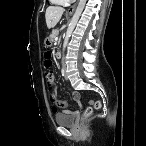 File:Closed loop small bowel obstruction due to adhesive bands - early and late images (Radiopaedia 83830-99014 C 94).jpg