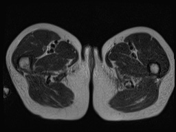 Closed loop small bowel obstruction in pregnancy (MRI) (Radiopaedia 87637-104031 D 51).jpg