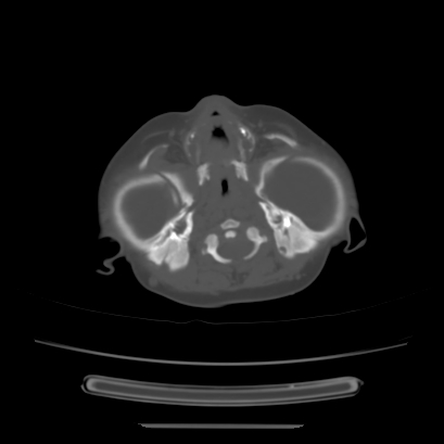 Cloverleaf skull (Radiopaedia 91901-109710 Axial bone window 42).jpg