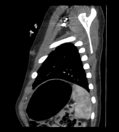 Coarctation of aorta (Radiopaedia 27427-27622 Sagittal C+ CTPA 126).png