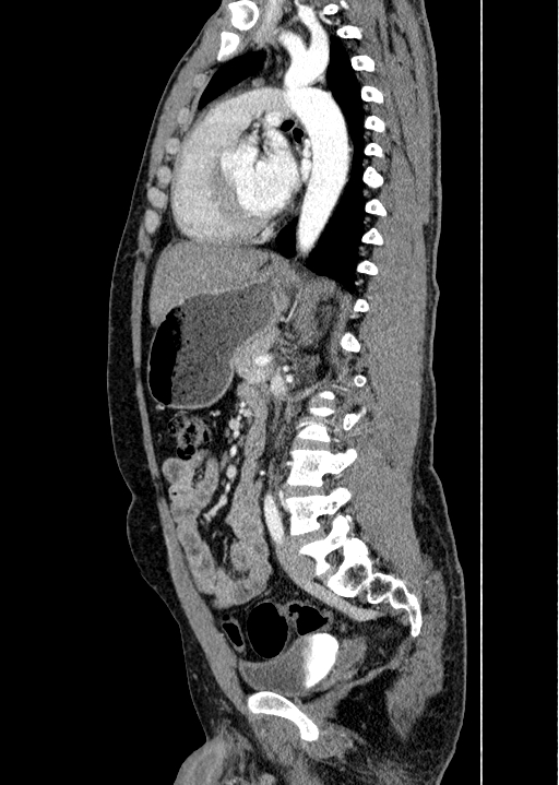 Coarctation of the aorta (Radiopaedia 49784-55050 C 65).jpg