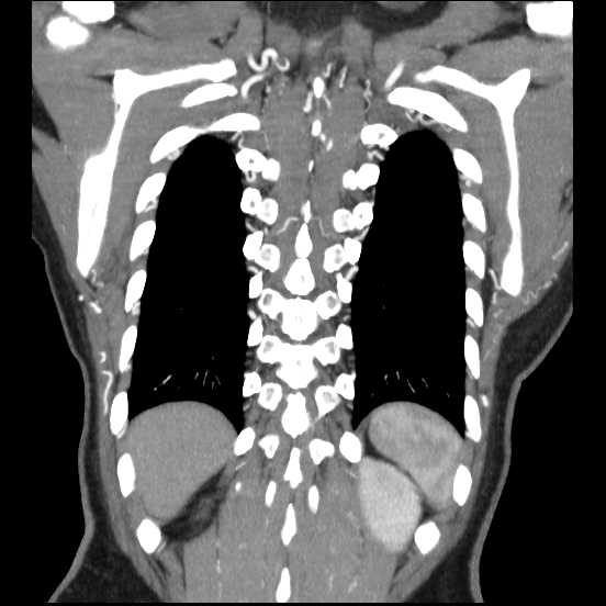 Coarctation of the aorta (Radiopaedia 67609-77010 B 12).jpg