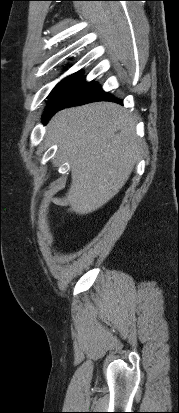 Coarctation of the aorta (Radiopaedia 74632-88521 C 30).jpg