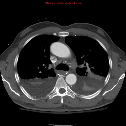File:Coarctation of the aorta (Radiopaedia 8681-9490 B 26).jpg