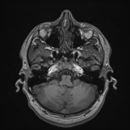 File:Cochlear incomplete partition type III associated with hypothalamic hamartoma (Radiopaedia 88756-105498 Axial T1 54).jpg