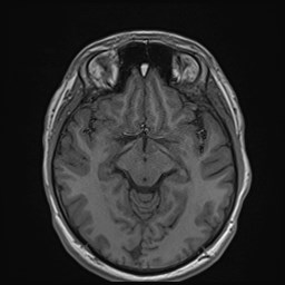 Cochlear incomplete partition type III associated with hypothalamic hamartoma (Radiopaedia 88756-105498 Axial T1 92).jpg