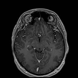 Cochlear incomplete partition type III associated with hypothalamic hamartoma (Radiopaedia 88756-105498 Axial T1 C+ 93).jpg