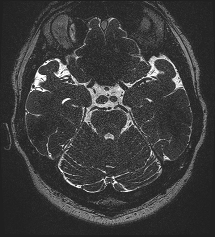 Cochlear incomplete partition type III associated with hypothalamic hamartoma (Radiopaedia 88756-105498 Axial T2 128).jpg