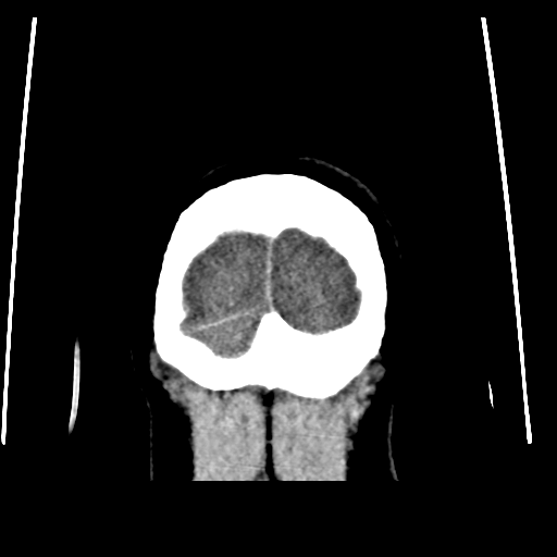 Colloid cyst (resulting in death) (Radiopaedia 33423-34469 Coronal non-contrast 52).png