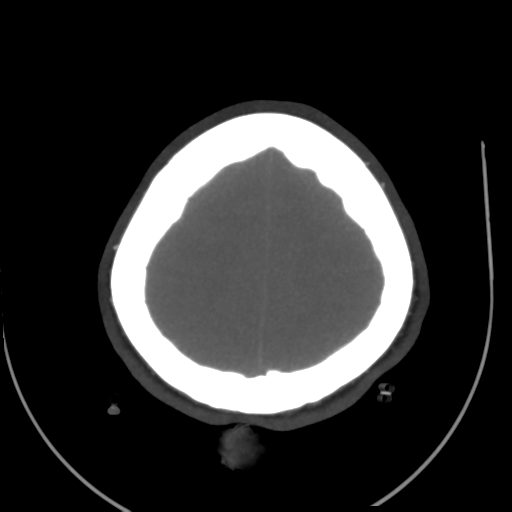 File:Colloid cyst (resulting in death) (Radiopaedia 33423-34499 A 49).png