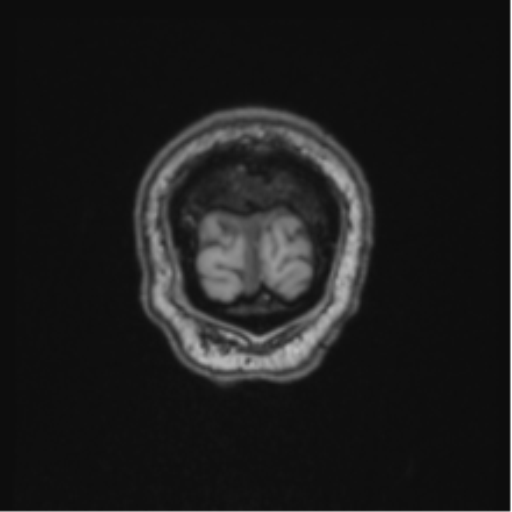 Colloid cyst of the third ventricle (Radiopaedia 86571-102662 Coronal T1 7).png