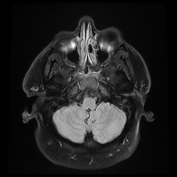 File:Colloid cyst with anterior communicating artery aneurysm (Radiopaedia 33901-35091 Axial FLAIR 4).jpg