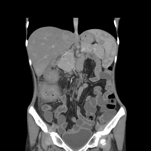 File:Colocolic fistula - Crohn disease (Radiopaedia 57063-63955 B 19).jpg
