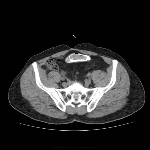File:Colocutaneous fistula in Crohn's disease (Radiopaedia 29586-30093 D 27).jpg