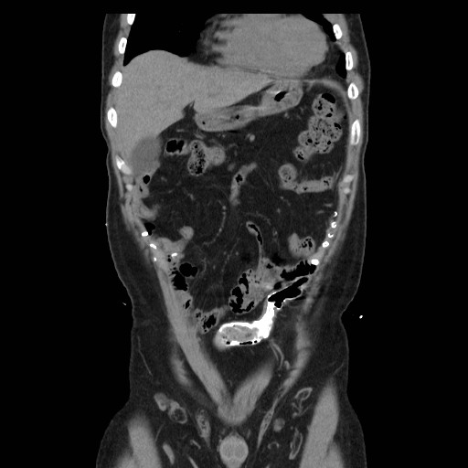 File:Colocutaneous fistula in Crohn's disease (Radiopaedia 29586-30093 E 4).jpg