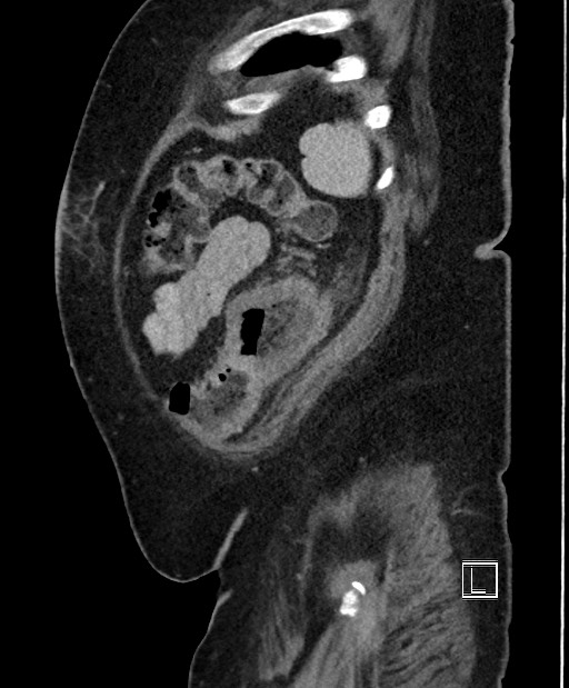 Colon adenocarcinoma (Radiopaedia 59374-66735 C 13).jpg