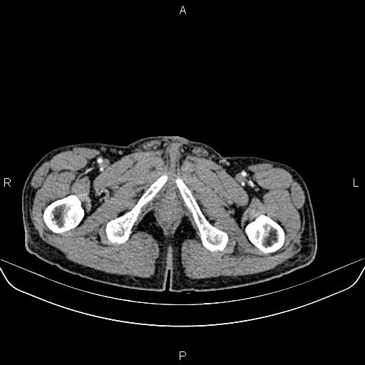 Colon adenocarcinoma - hepatic flexure (Radiopaedia 85635-101395 A 105).jpg