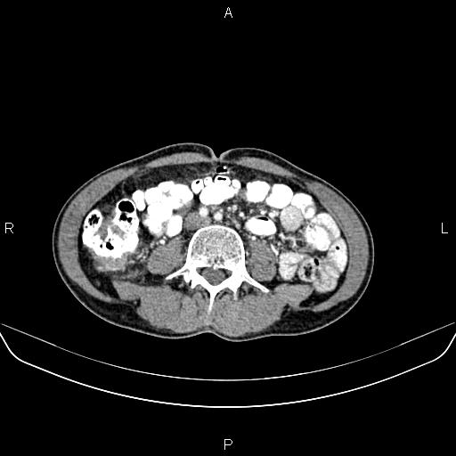 Colon adenocarcinoma - hepatic flexure (Radiopaedia 85635-101395 A 52).jpg