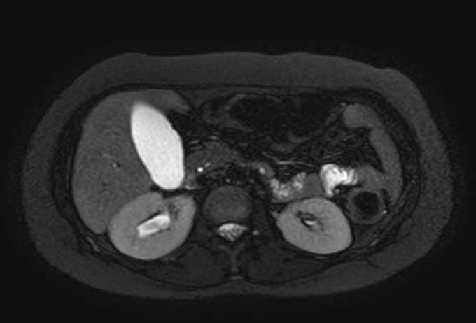 Colon adenocarcinoma with Krukenberg tumors, advanced pregnancy (Radiopaedia 67279-76645 Axial T2 SPAIR 54).jpg