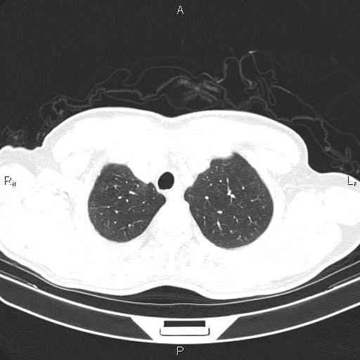 File:Colon cancer (Radiopaedia 85663-101443 Axial lung window 10).jpg