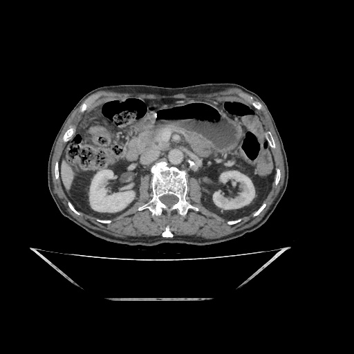 Colon cancer (ultrasound) (Radiopaedia 77249-89300 A 67).jpg