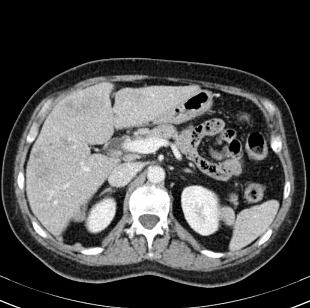 Colon carcinoma with hepatic metastases (Radiopaedia 29477-29961 A 35).jpg