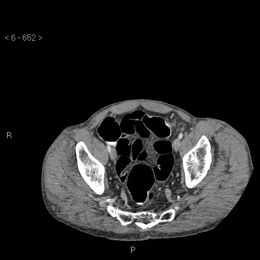 File:Colonic cancer (ultrasound and TC imaging) (Radiopaedia 50346-55713 A 121).jpg
