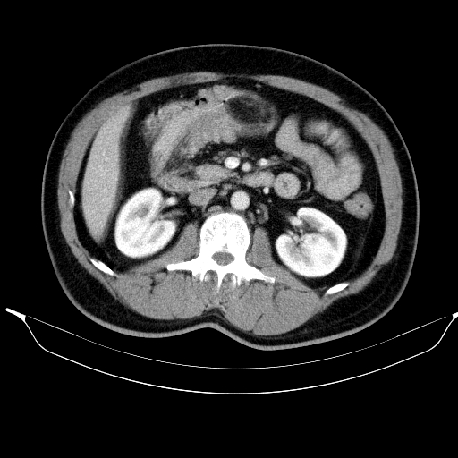 Colonic lipoma with colo-colic intussusception (Radiopaedia 58944-66200 A 26).jpg