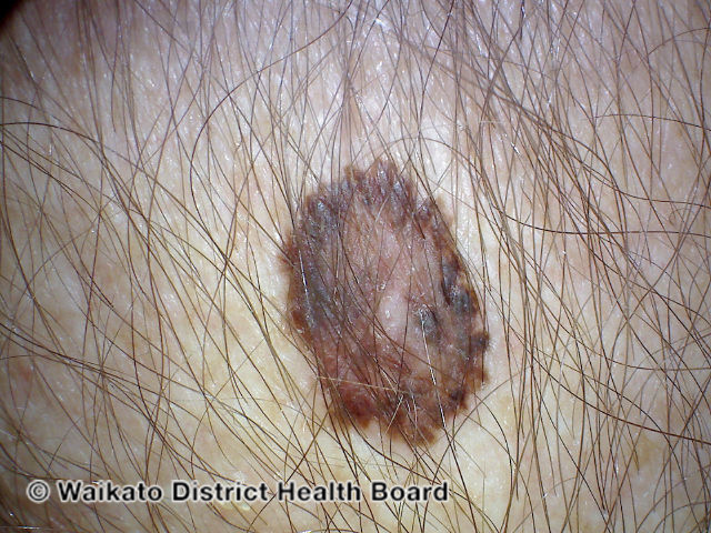 File:Melanoma in situ (DermNet NZ melanoma-abcd-11).jpg