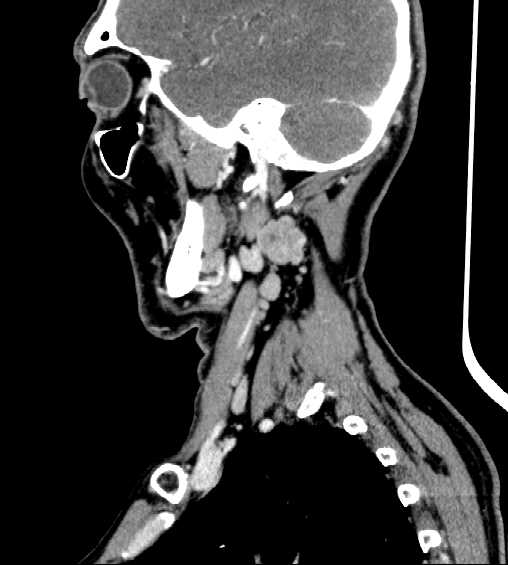 File:Nasopharyngeal carcinoma - infiltrating the clivus (Radiopaedia 62583-70875 C 40).jpg