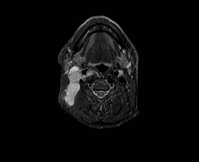 File:Nasopharyngeal carcinoma with perineural spread (Radiopaedia 55030-61380 Axial STIR 16).jpg