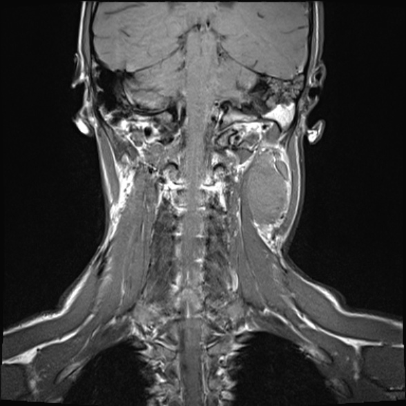 Nasopharyngeal carcinoma with skull base invasion (Radiopaedia 53415-59485 Coronal T1 8).jpg