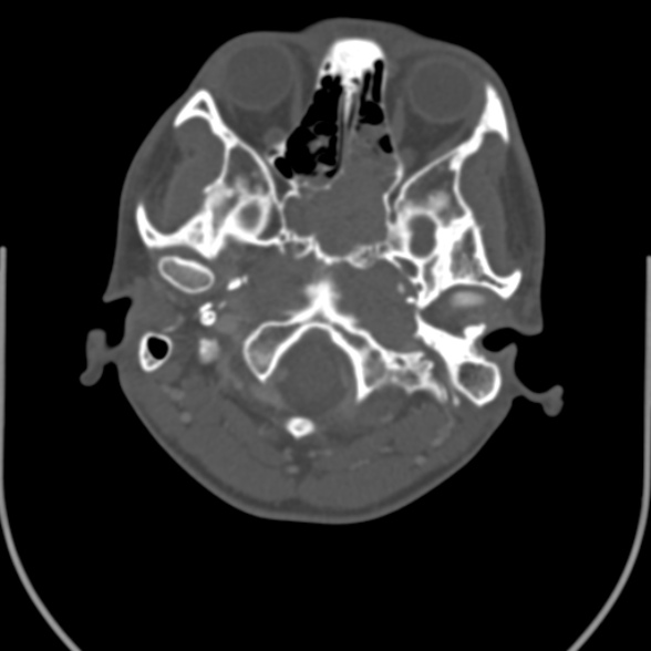 Nasopharyngeal carcinoma with skull base invasion (Radiopaedia 53415-59705 Axial bone window 27).jpg