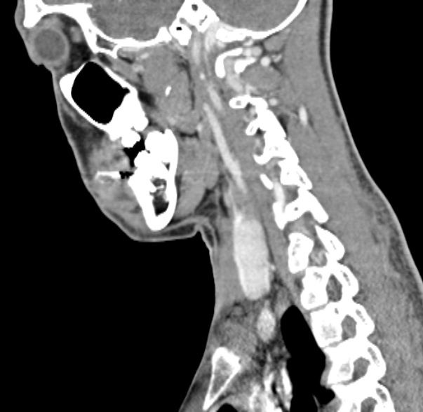 Nasopharyngeal carcinoma with skull base invasion (Radiopaedia 53415-59705 C 23).jpg