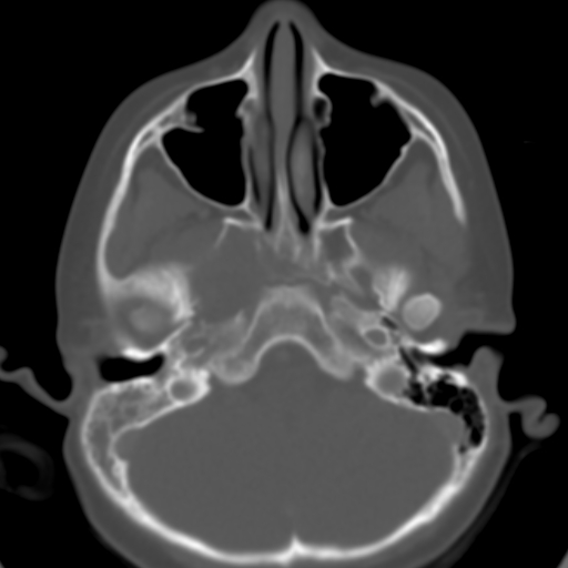 File:Nasopharyngeal rhabdomyosarcoma (Radiopaedia 23417-23491 Axial bone window 9).jpg