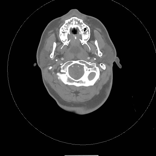 Neck CT angiogram (intraosseous vascular access) (Radiopaedia 55481-61945 B 246).jpg