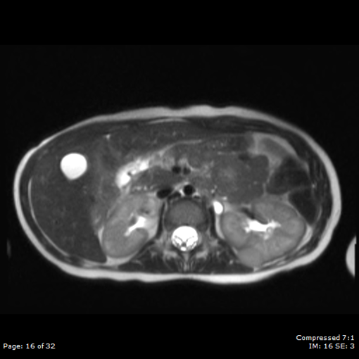 File:Nephroblastomatosis (Radiopaedia 39984-42478 Axial T2 1).png