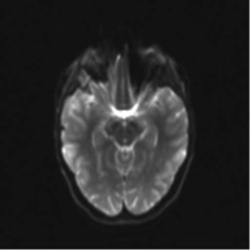 Neurenteric cyst (Radiopaedia 58641-65837 Axial DWI 16).png