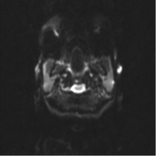 Neurenteric cyst (Radiopaedia 58641-65837 Axial DWI 2).png