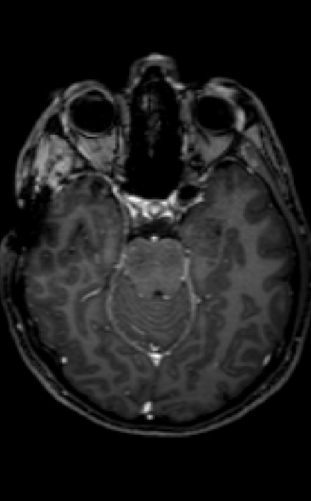 Neuro-Behçet disease (Radiopaedia 90112-107294 Axial T1 C+ 152).jpg