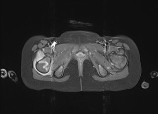 File:Neuroblastoma with bone metastases (Radiopaedia 67080-76414 Axial T1 C+ fat sat 44).jpg