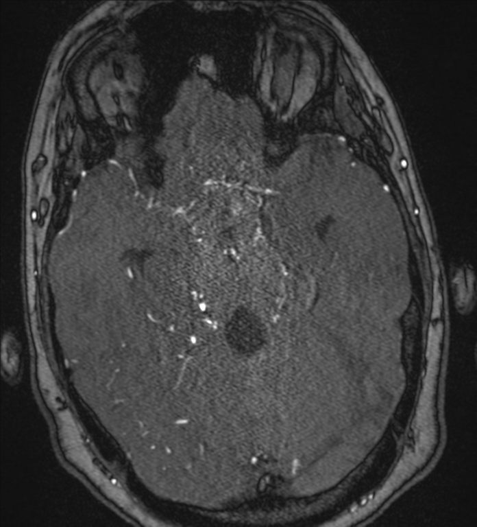 Neurofibromatosis type 1 - head and neck - CNS manifestations (Radiopaedia 49910-55188 Axial MRA 31).png