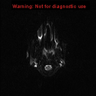 File:Neurofibromatosis type 1 with optic nerve glioma (Radiopaedia 16288-15965 Axial DWI 24).jpg