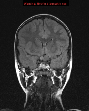 File:Neurofibromatosis type 1 with optic nerve glioma (Radiopaedia 16288-15965 Coronal FLAIR 16).jpg