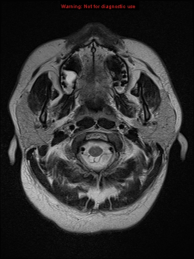 File:Neuroglial cyst (Radiopaedia 10713-11184 Axial T2 22).jpg