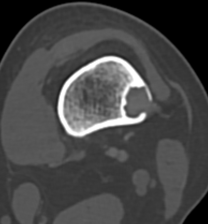 Non-ossifying fibroma - femur (Radiopaedia 82786-97042 Axial bone window 43).jpg