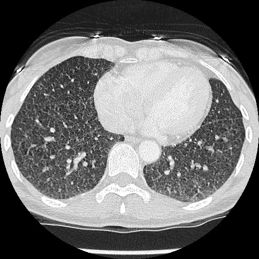 File:Non-small cell lung cancer with miliary metastases (Radiopaedia 23995-24193 Axial lung window 17).jpg