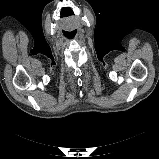 File:Non Hodgkin lymphoma in a patient with ankylosing spondylitis (Radiopaedia 84323-99624 Axial non-contrast 1).jpg