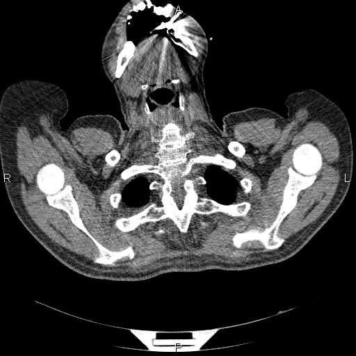 File:Non Hodgkin lymphoma in a patient with ankylosing spondylitis (Radiopaedia 84323-99624 Axial non-contrast 4).jpg