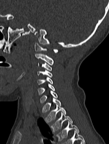 Normal CT cervical spine - pediatric (Radiopaedia 52549-58462 Sagittal bone window 55).jpg